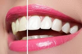 Imagen de Blanqueamiento Dental Profesional
