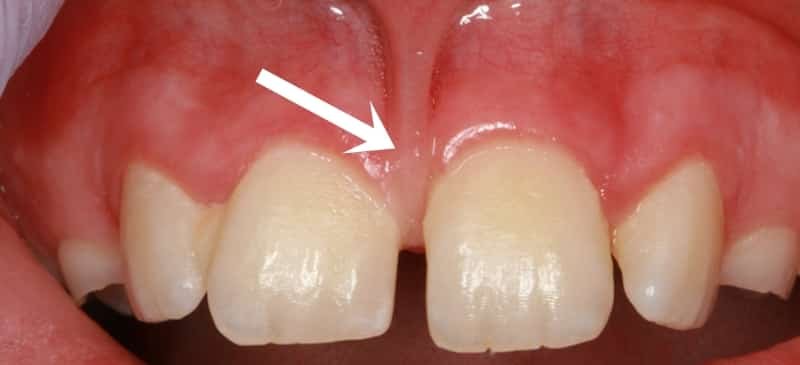 Imagen de Cirugía de Frenillo (Frenectomía)